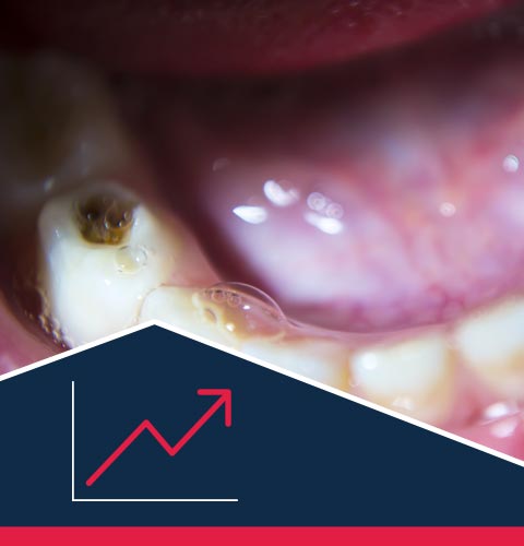 Child's mouth with dark spot on tooth