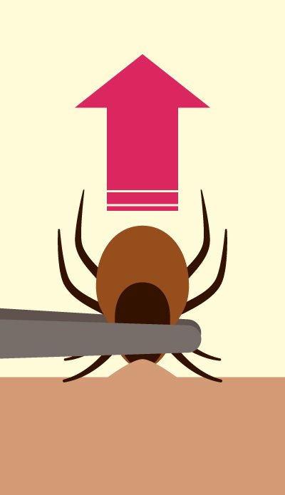 Vector illustration of tweezers removing a tick from human skin